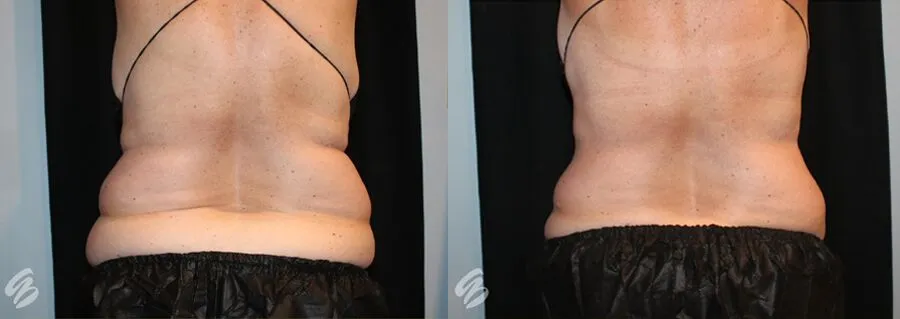 Semaglutide Weight Loss Cincinnati
