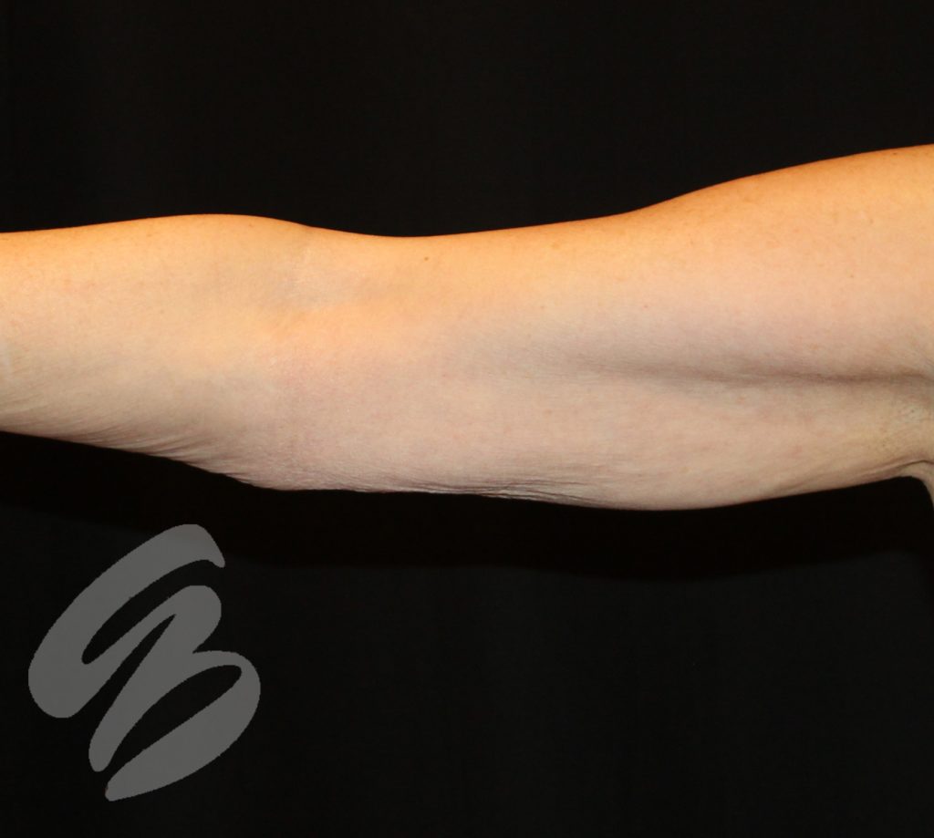 Arm with significantly tighter skin