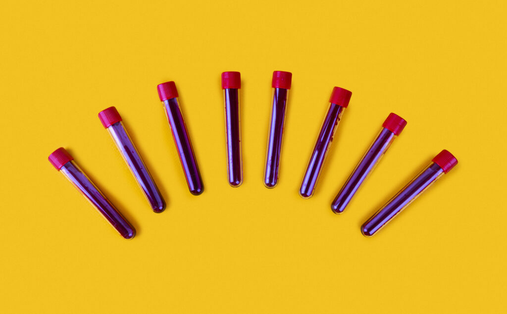 how is insulin resistance diagnosed