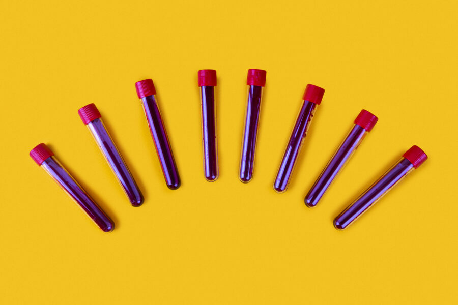 how is insulin resistance diagnosed