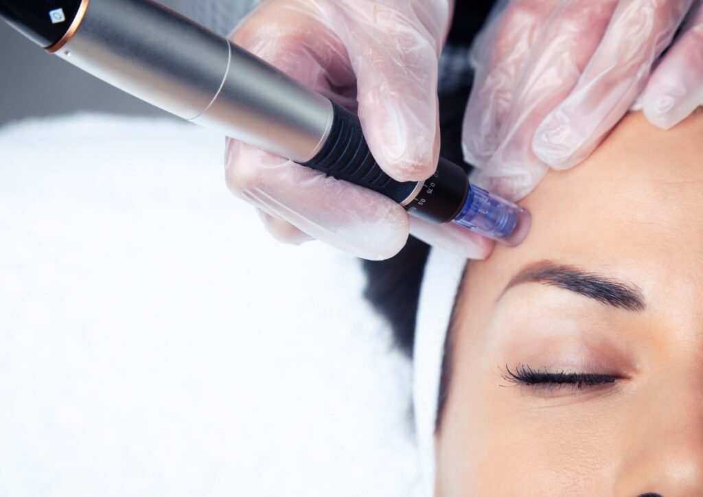 woman receiving microneedling