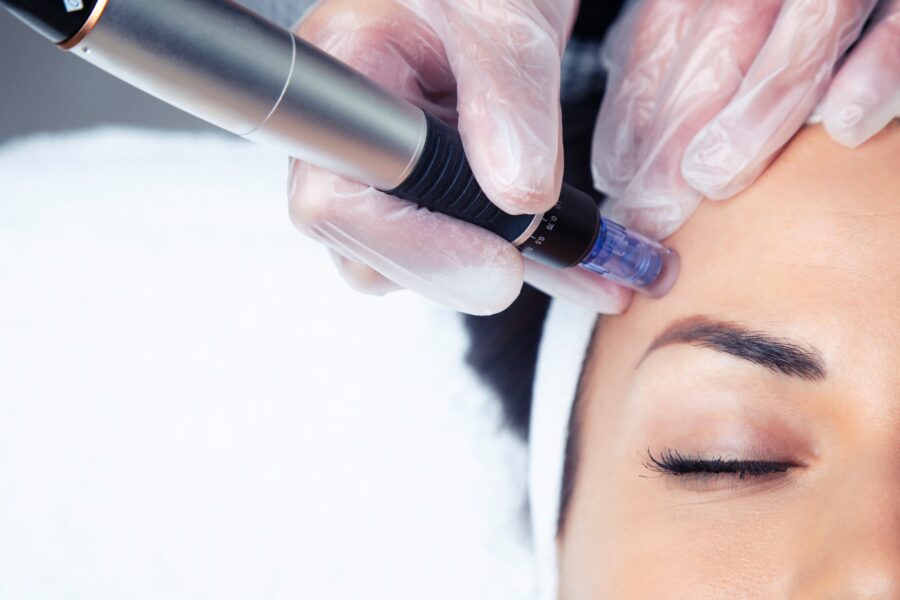 woman receiving microneedling