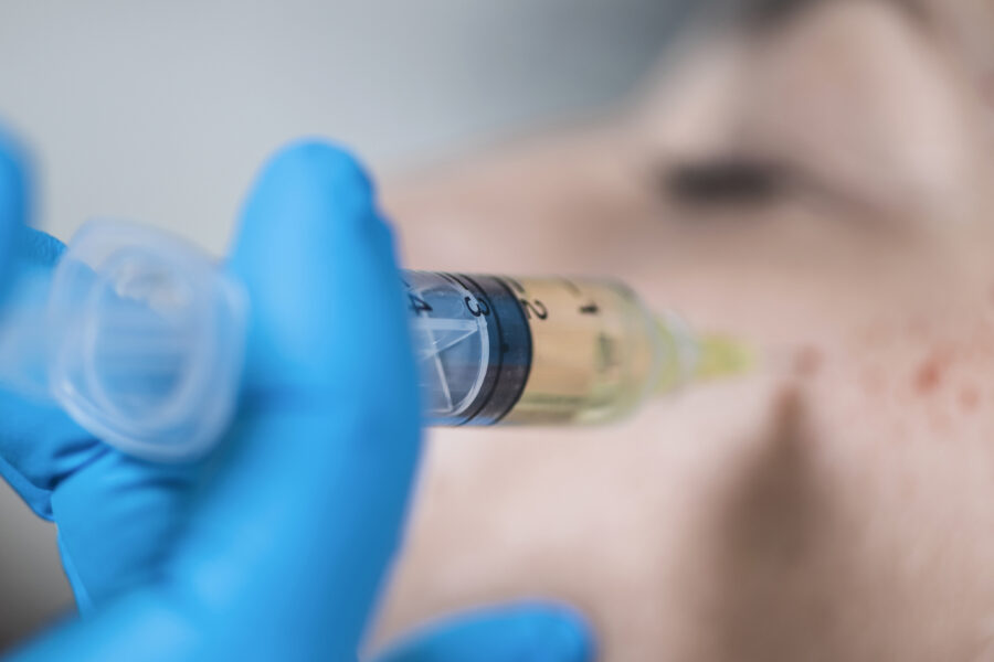 Close up of a PRP non-surgical facelift in Cincinnati