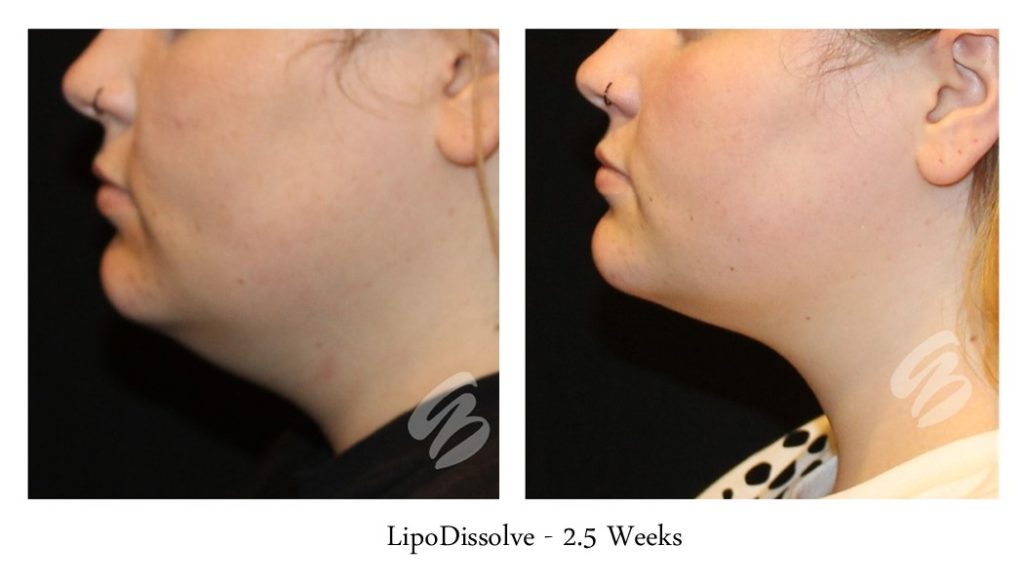 lipodissolve and kybella neck procedures before and after