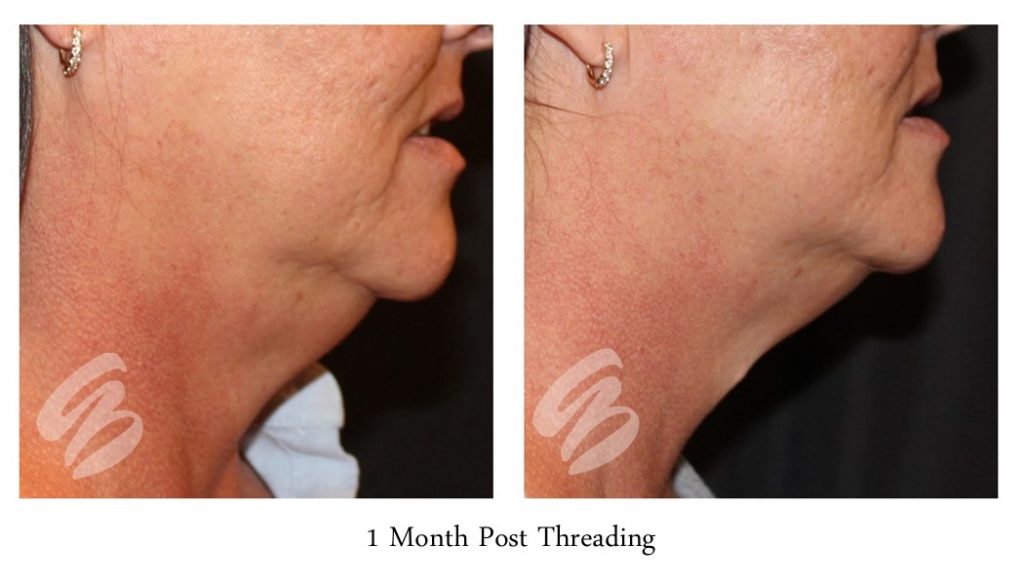 before and after cosmetic threads neck tightening procedure in Cincinnati