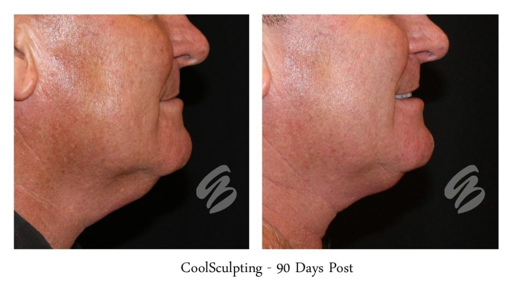before and after CoolSculpting neck tightening procedure in Cincinnati