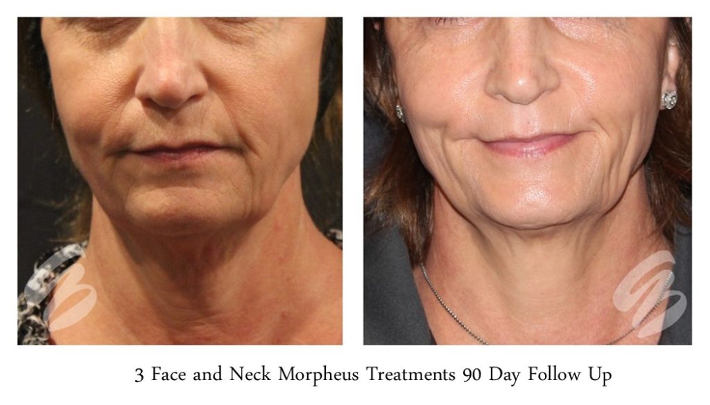 before and after morpheus8 neck tightening procedures in Cincinnati