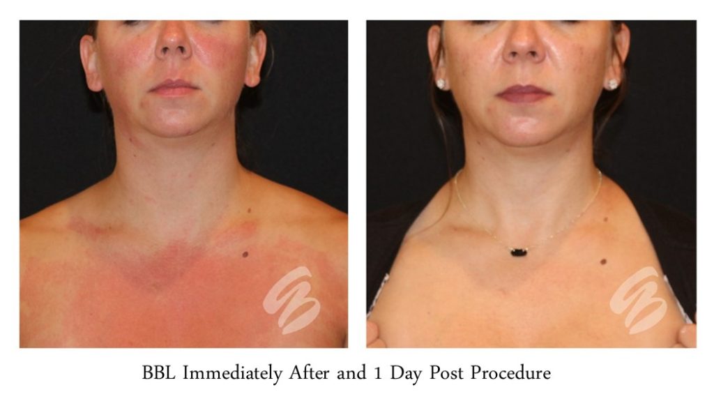 woman's skin immediately after a BBL facial treatment in Cincinnati and 1 day post procedure