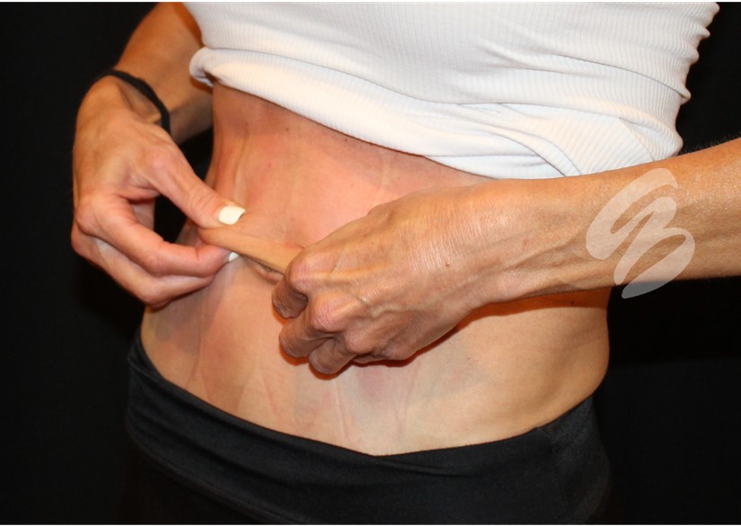 after photo of tighter abdomen skin