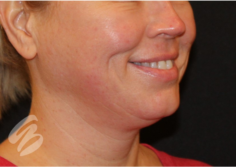 woman's lower face with a smoother complexion after CO2 laser results