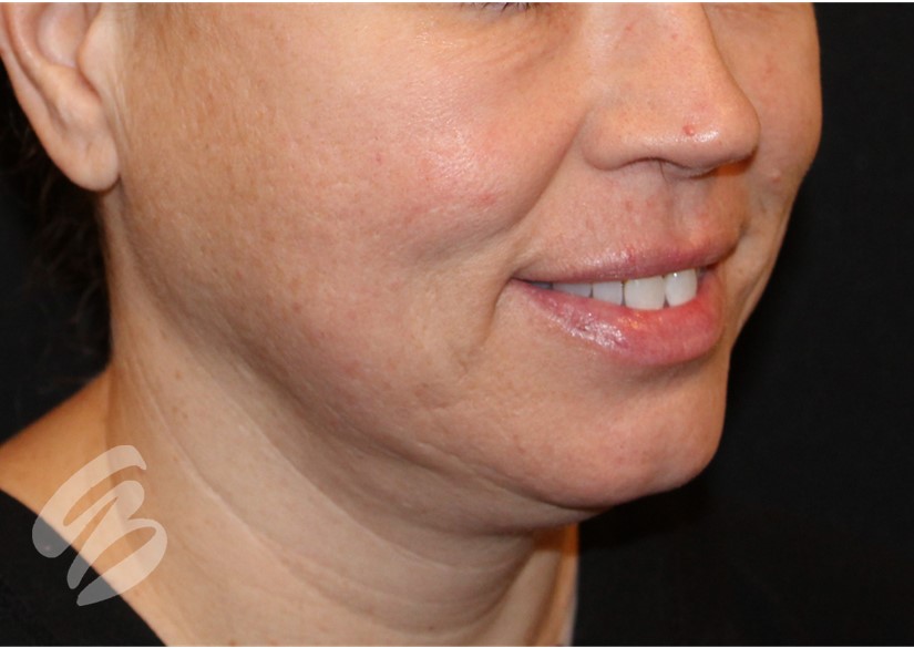 woman's lower face before CO2 laser resurfacing results
