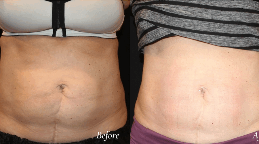 Evolve before and after body contouring