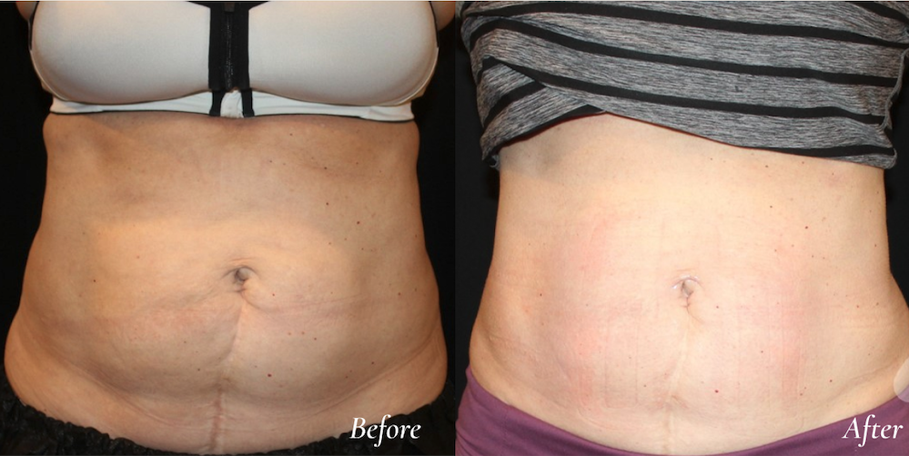 Evolve before and after body contouring