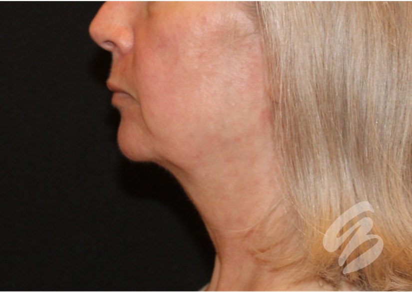 woman's rejuvenated side profile after CO2 laser