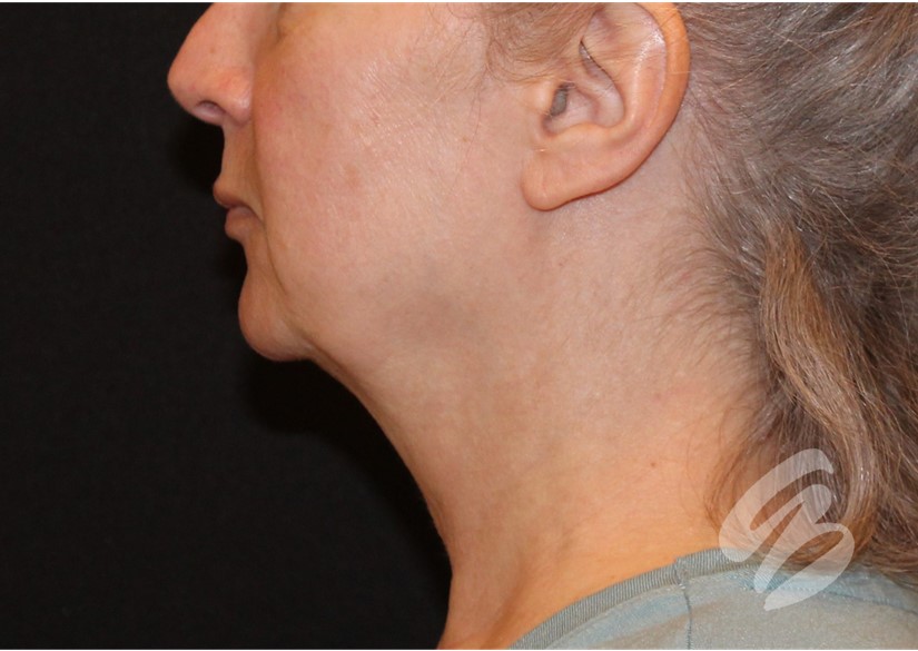 woman's side profile before CO2 laser