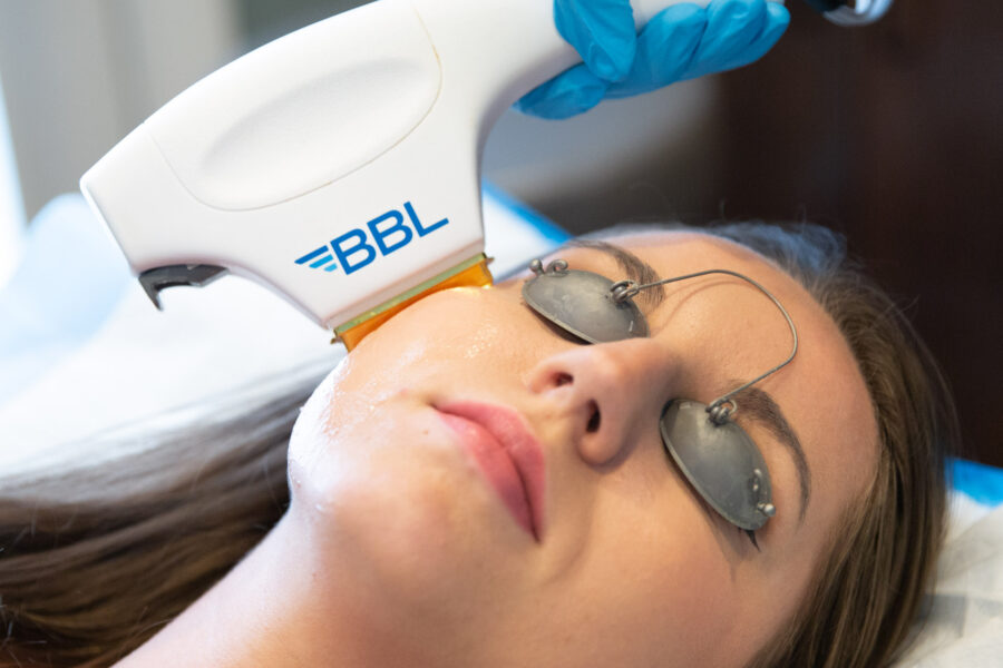 Close up of a woman during a Hyperpigmentation Treatment in Cincinnati using the Forever Young BBL handpiece on the side of her face.