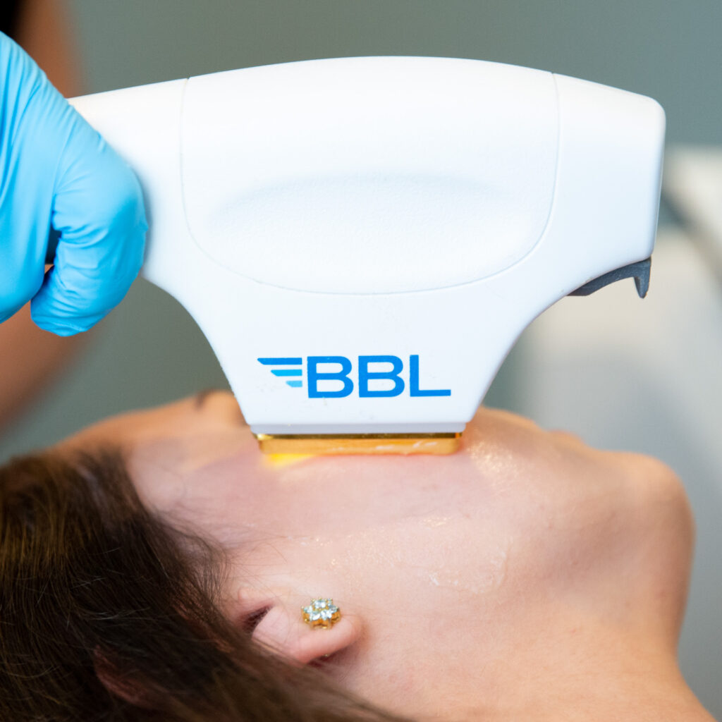 Close up of the Forever Young BBL handpiece against a woman's face for Acne Treatment in Cincinnati.