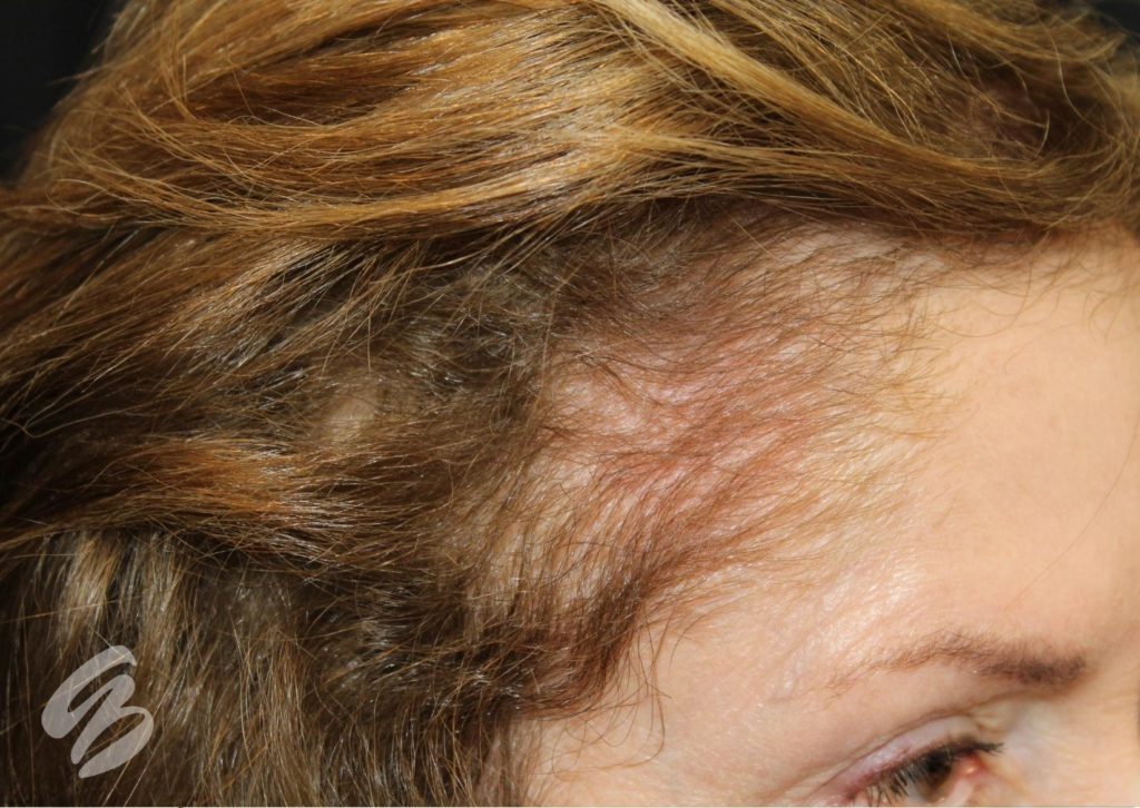 Hair Restoration - Amy Brenner, MD & Associates
