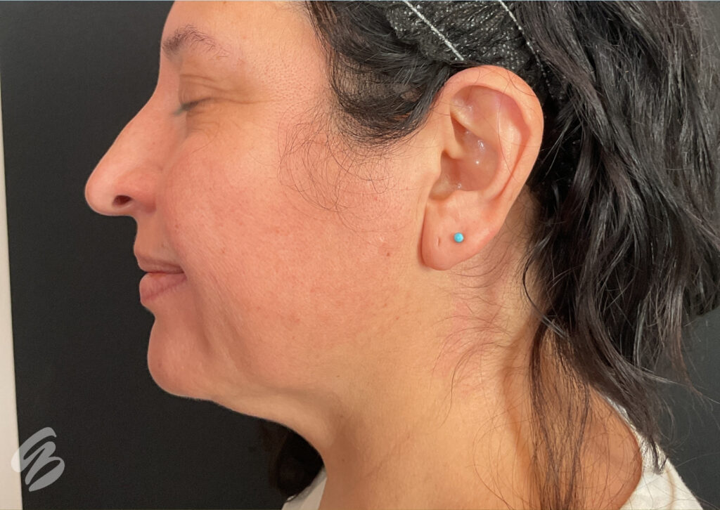 side profile of woman before morpheus8 treatment