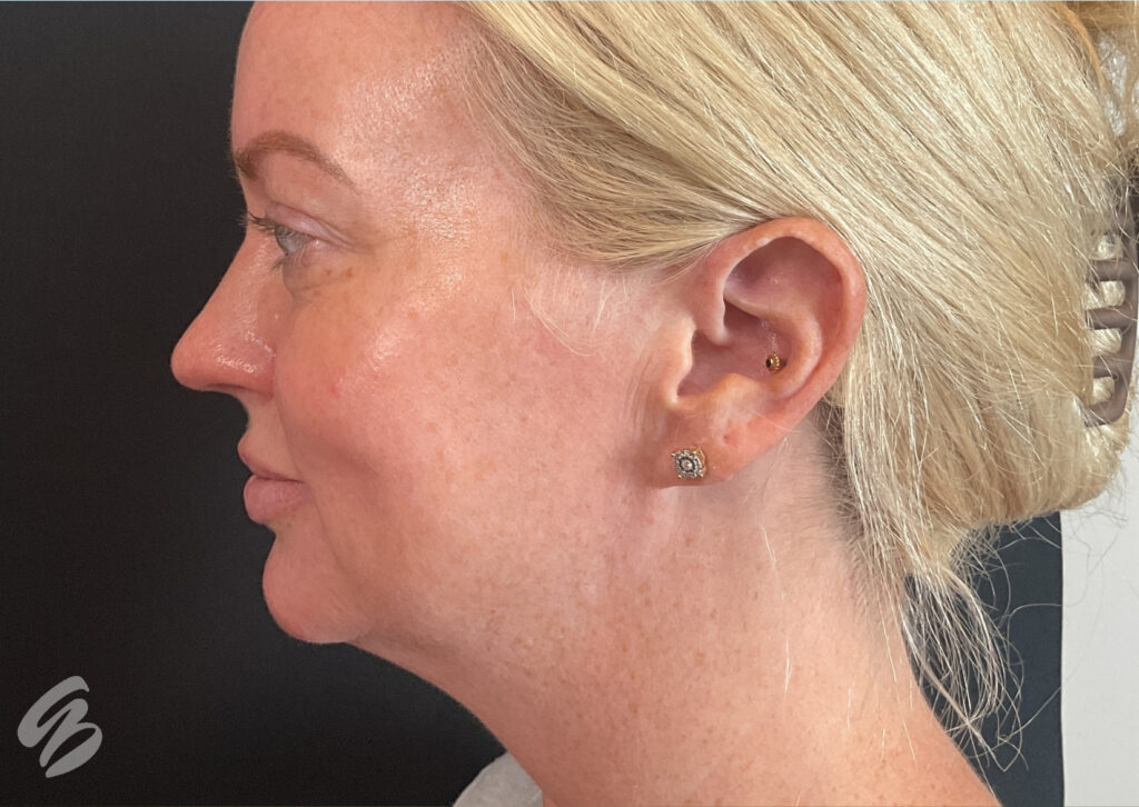 side profile of woman before morpheus8 treatment
