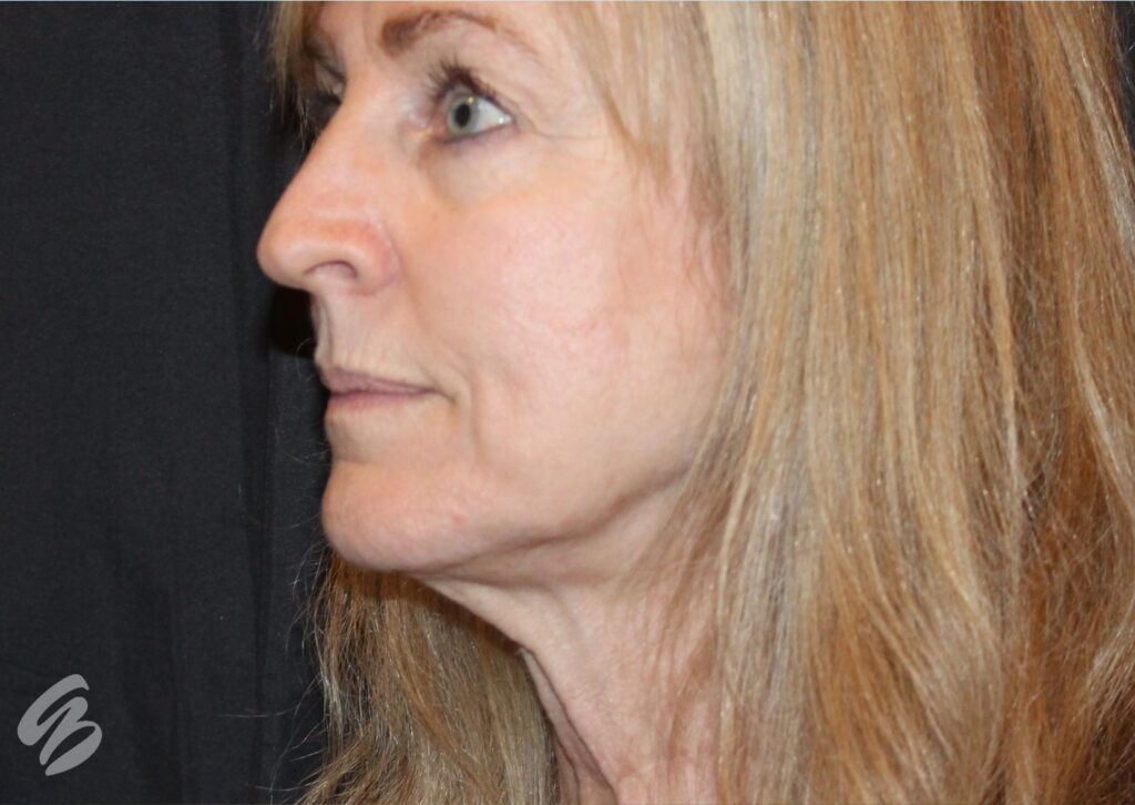 woman's face in side profile before a morpheus8 treatment