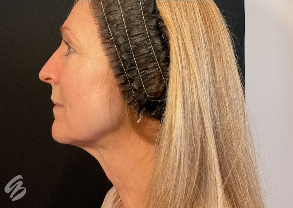 woman's face in side profile showing results after a morpheus8 treatment
