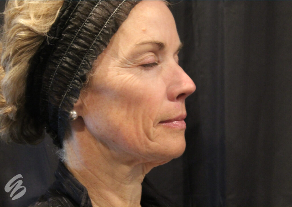 woman's face in side profile before a morpheus8 treatment