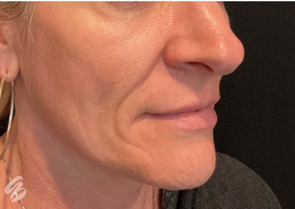 up close of right cheek skin showing signs of aging and deep nasal folds before sculptra