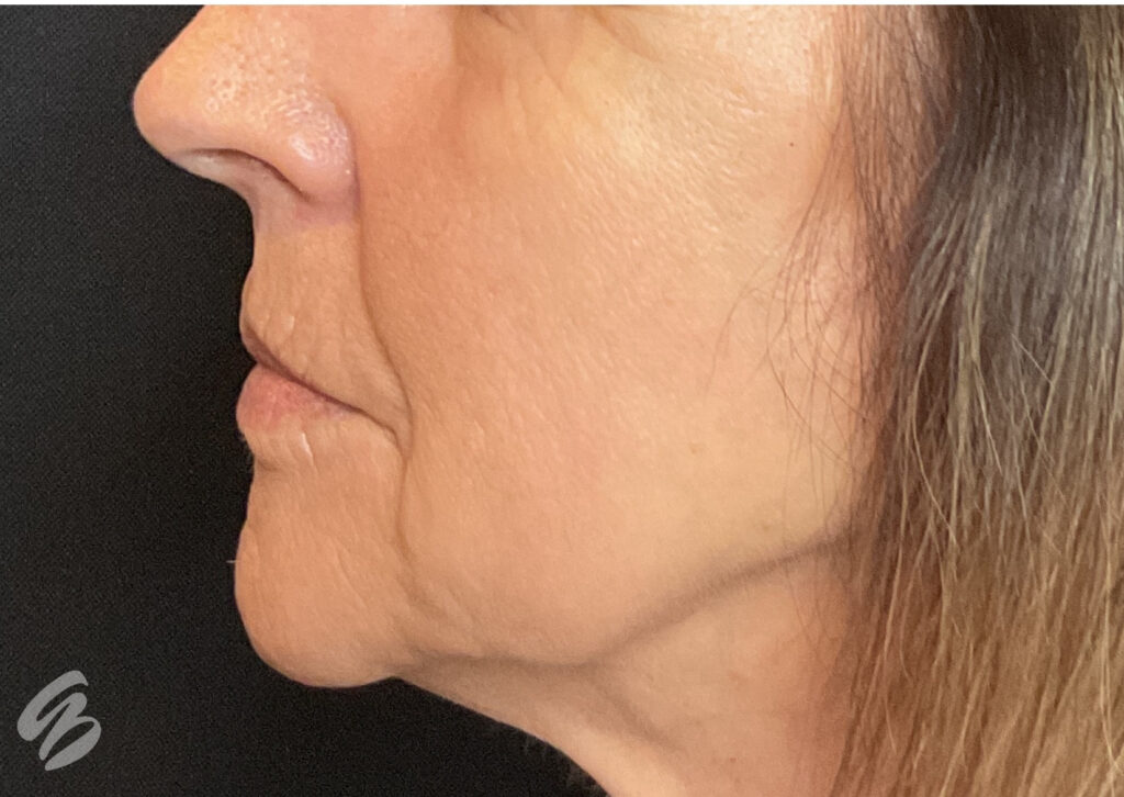 up close of left face cheek, showing dry skin before skinvive