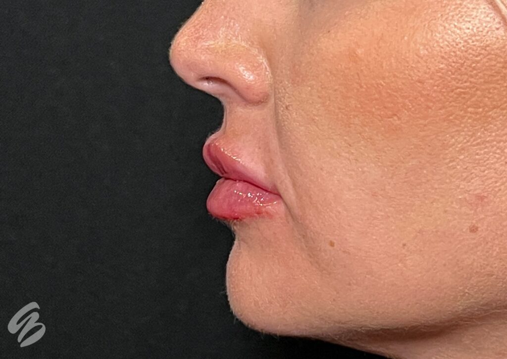 up close of left cheek showing dryness before treatment of skinvive
