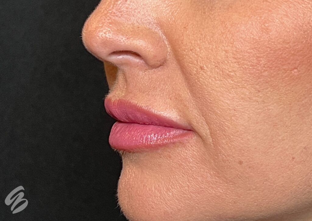 up close quarter turn of left cheek showing dryness before treatment of skinvive