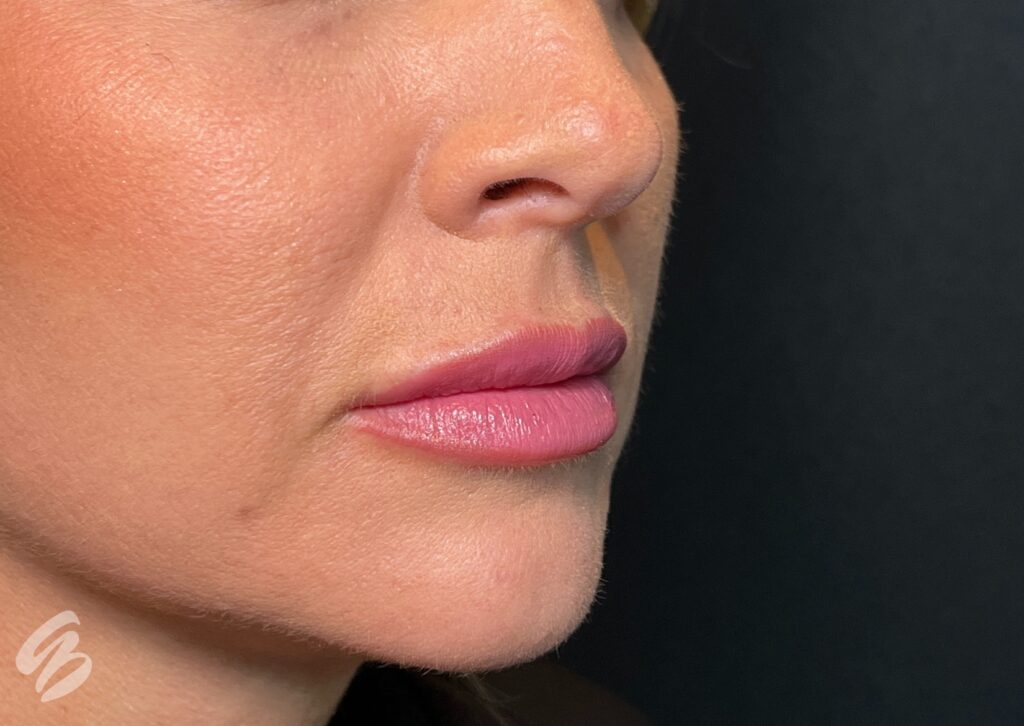 up close quarter turn of right cheek showing dryness before treatment of skinvive