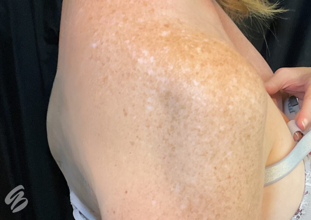 up close of right shoulder showing pigmentation on a fitz 1 skin type before treatment of bbl