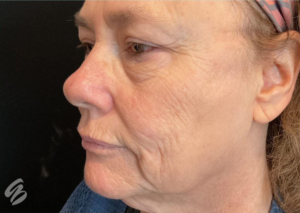 up close of left check showing signs of aging and lack of volume before sculptra