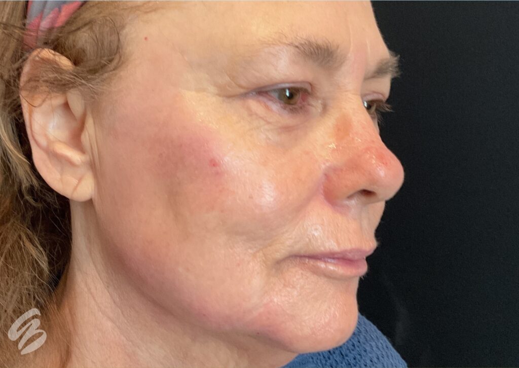 up close of right check rejuvenated skin after sculptra