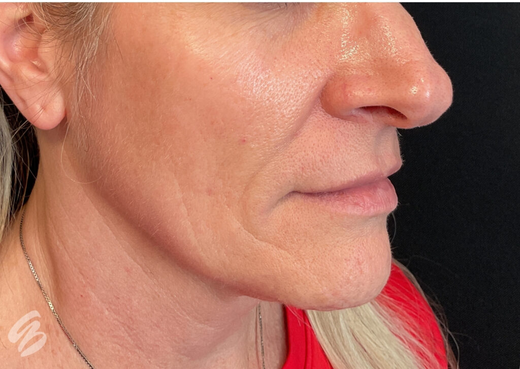 up close of right cheek skin showing signs of aging and softening of deep nasal folds after sculptra