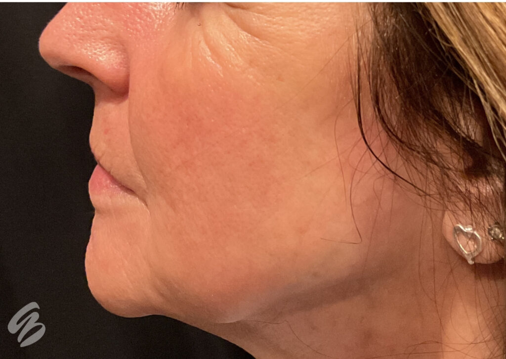 up close of left face cheek, showing hydrated skin after skinvive