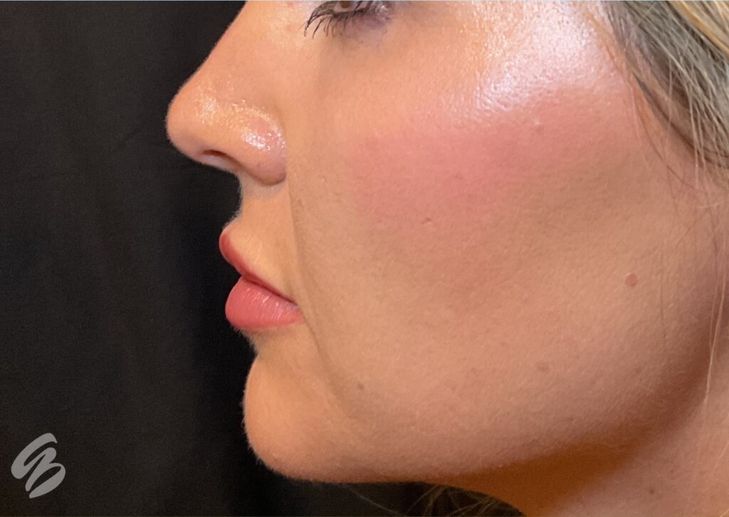 up close of left cheek showing hydration and glow after treatment of skinvive