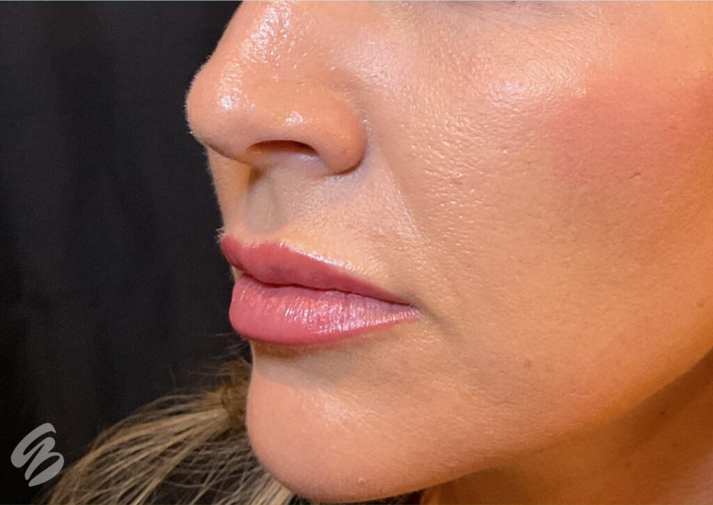 up close quarter turn of left cheek showing hydration and glow after treatment of skinvive