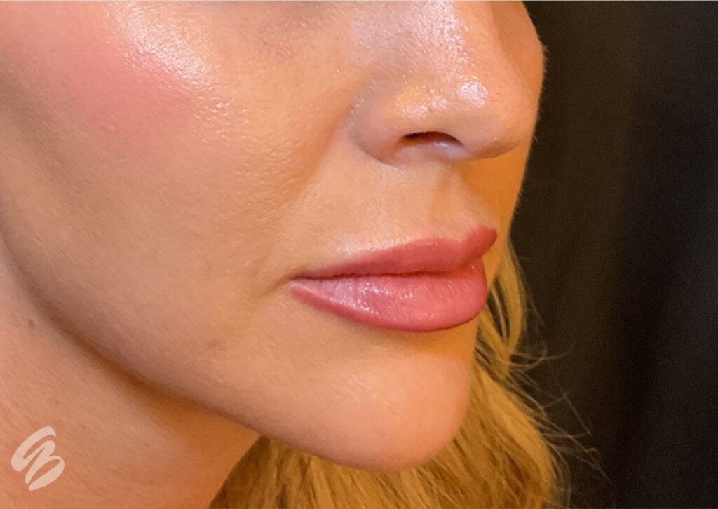 up close quarter turn of right cheek showing hydration and glow after treatment of skinvive