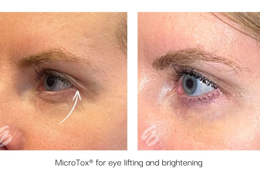 Close up of a woman's eye before and after Botox in Mason, OH