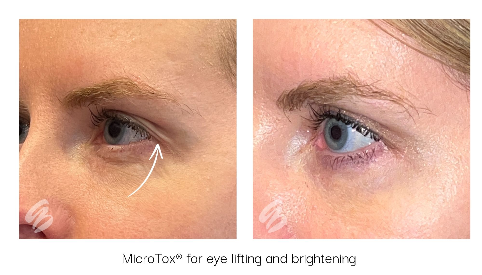 Close up of a woman's eye before and after Botox in Mason, OH