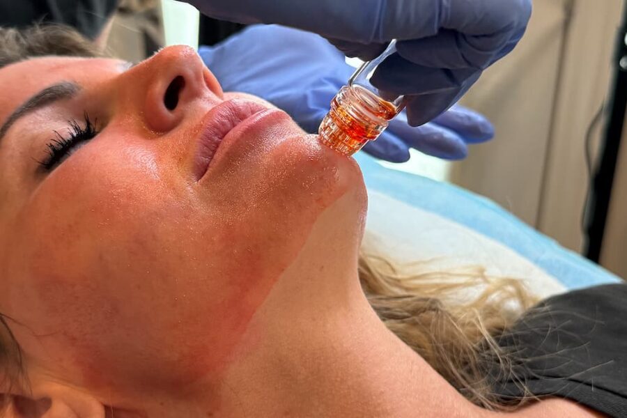Close up of a woman's face as she undergoes a skin treatment called microchanneling, one of our Best Facials for Aging Skin in Cincinnati.