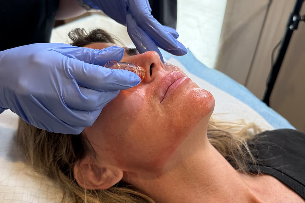 Close up of a woman's face as a gloved medical provider administers microchanneling in Cincinnati using a small, clear tool.