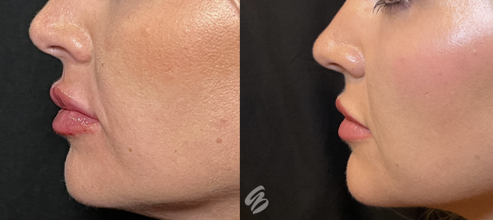 The profile of a woman's face before and after she got treatment using anti-aging injectables in Cincinnati.