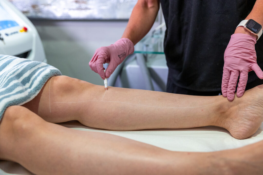 Close up of a patient's legs as they lay on a treatment table while a medical provider marks their skin for Laser hair removal in Mason.