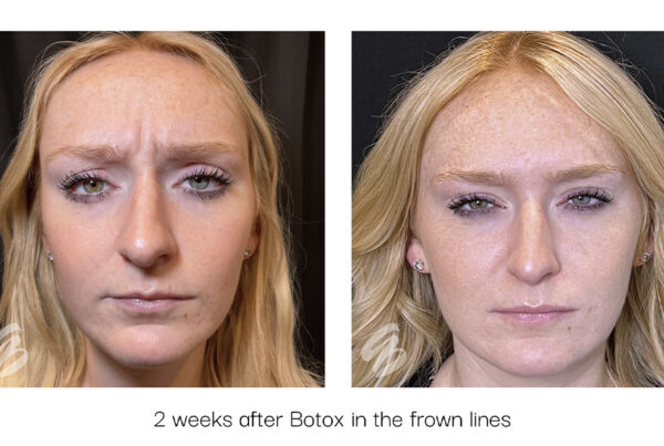 Before and after images of frown lines after Botox in Cincinnati.