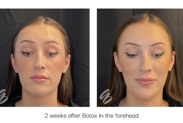 Before and after images of a woman's forehead after Botox in Cincinnati.