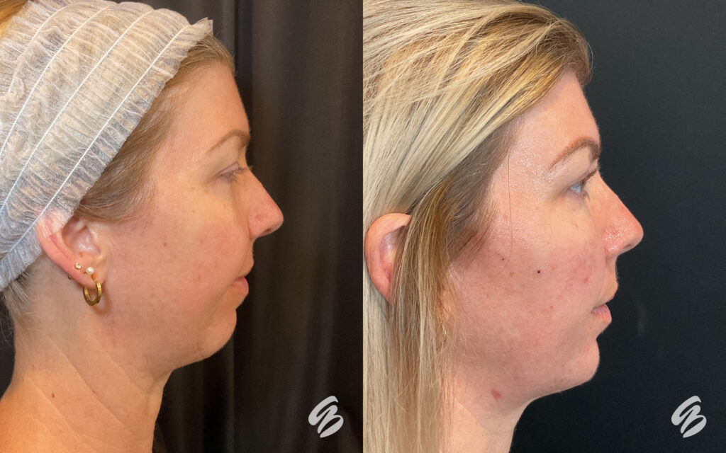Before and after photo of patient who received treatment for dermal filler in Mason, OH. Her face now appears more balanced, as the injector placed small dosages in specific parts of her face for overall facial balance and harmony.