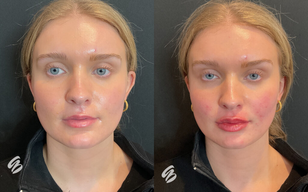 Before and after photo of patient who received lip filler in Cincinnati from Amy Brenner, MD & Associates. The after photo shows lips that have more volume, but still look natural.